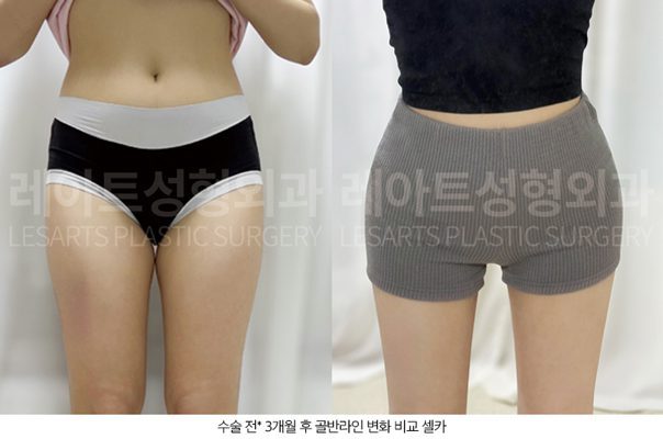 골반지방이식 비율 변화 - 레아트성형외과