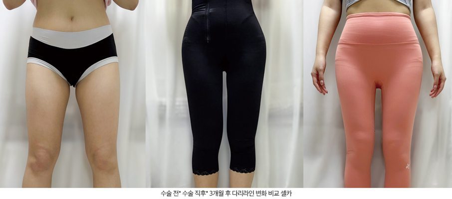 골반 지방이식 비율 변화 - 레아트성형외과