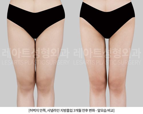 허벅지지방흡입 레아트 성형외과