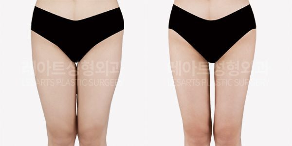 허벅지 지방흡입 전후사진 레아트 성형외과