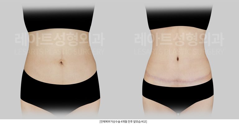 복부거상 잘하는 곳 레아트 성형외과