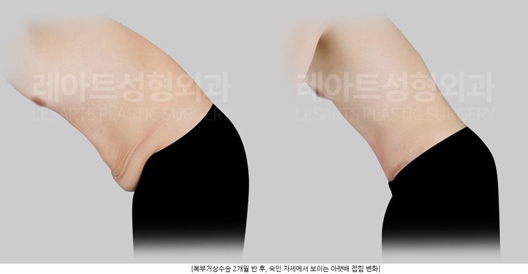 남성 복부거상수술 전후 변화 - 레아트성형외과