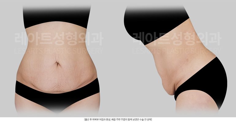 복부거상수술 전 상태 - 레아트성형외과