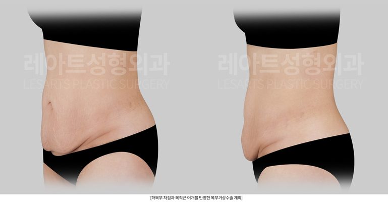 복부거상수술 디자인 - 레아트성형외과