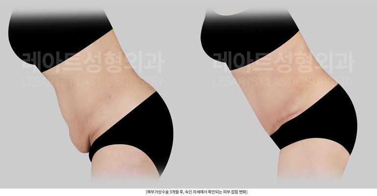 복부거상수술 후 복부주름 개선 효과 - 레아트성형외과
