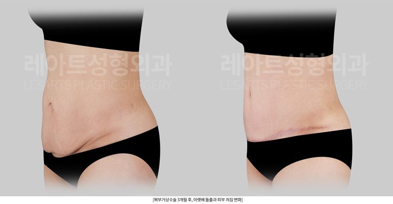 복부거상술 이후 복직근교정 전후 비교 - 레아트성형외과