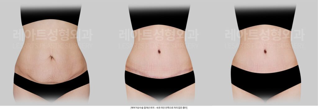 복부거상수술 흉터 위치 - 레아트성형외과