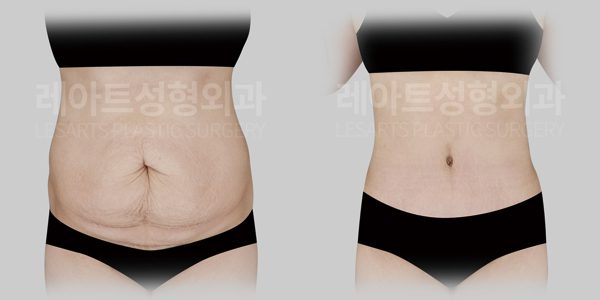 복부거상 전후사진 앞모습 레아트 성형외과