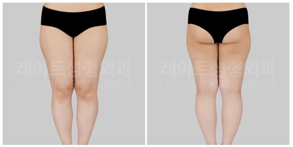 허벅지 지방흡입 수술 전 레아트 성형외과