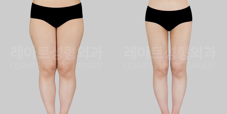 허벅지 지방흡입 전후사진