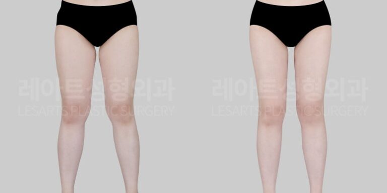 허벅지지방흡입 수술 전후 비교 앞모습