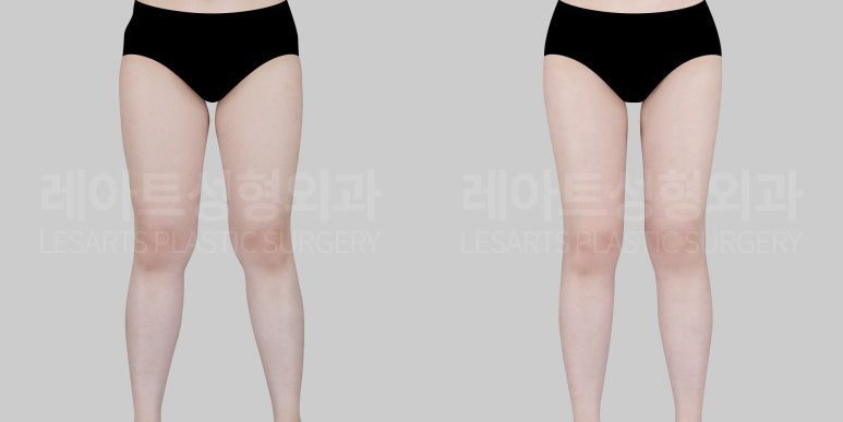 허벅지지방흡입 수술 전후 비교 앞모습