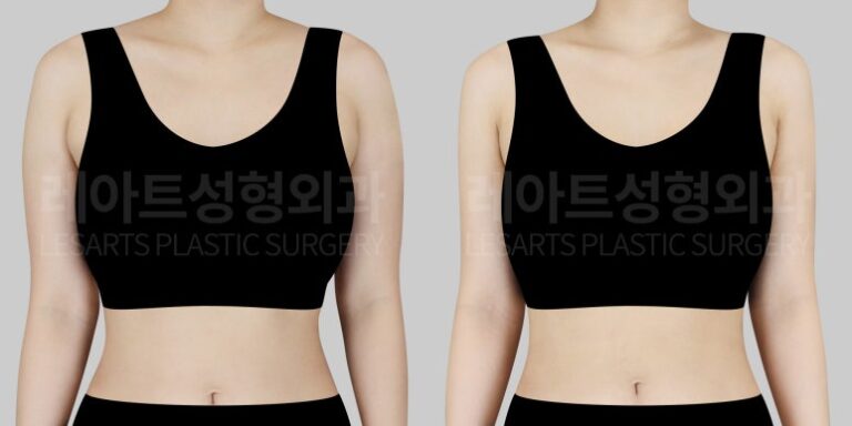 팔지방흡입 | 수영복 핏을 바꾸는 선택, 허벅지 팔 지방흡입 언제 해야 할까?