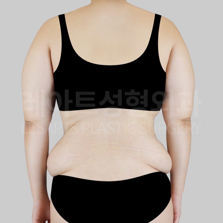 체중 감량 후 정리되지 않은 옆구리와 러브핸들
