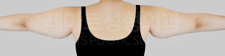 팔지방흡입 수술 전 저고리살 라인 - 후면