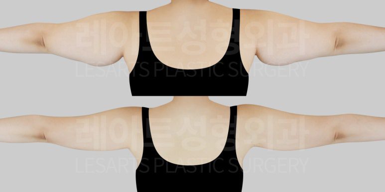 지방흡입의 처진 팔뚝살 개선 효과- 레아트 최평림 원장