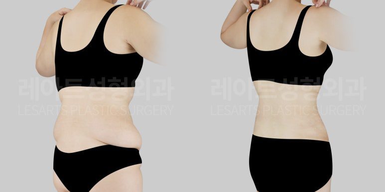 복부 지방흡입으로 옆구리, 러브핸들 살처짐 개선 - 레아트성형외과