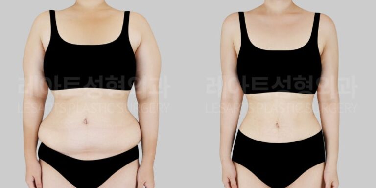 팔, 복부지방흡입 후 라인 변화 - 레아트성형외과