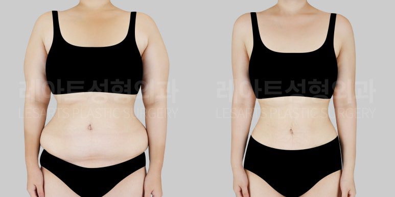 팔, 복부지방흡입 후 라인 변화 - 레아트성형외과