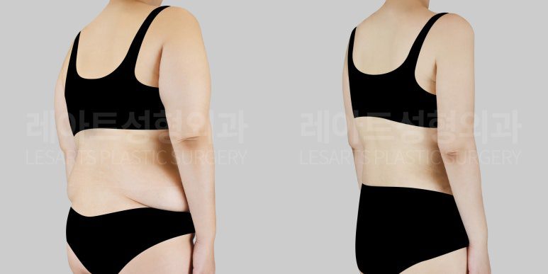 저고리살, 뒷볼록살 지방흡입 전후 차이 - 레아트 성형외과 최평림 원장