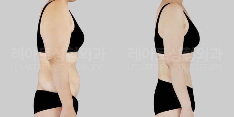 지방흡입 전후 둘레 차이 - 레아트성형외과 최평림 원장