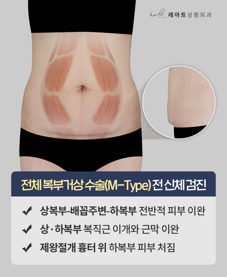 복부거상 수술 플랜