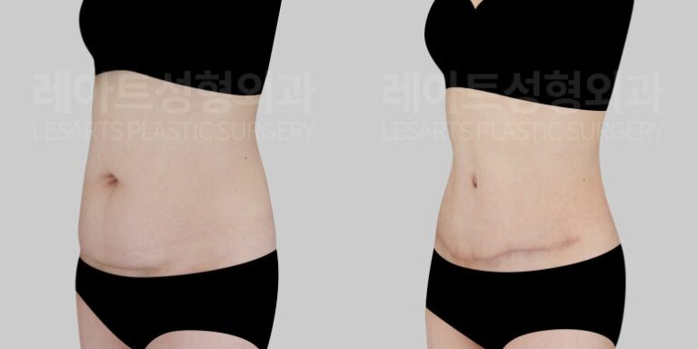 l-abdominoplasty-post21-06