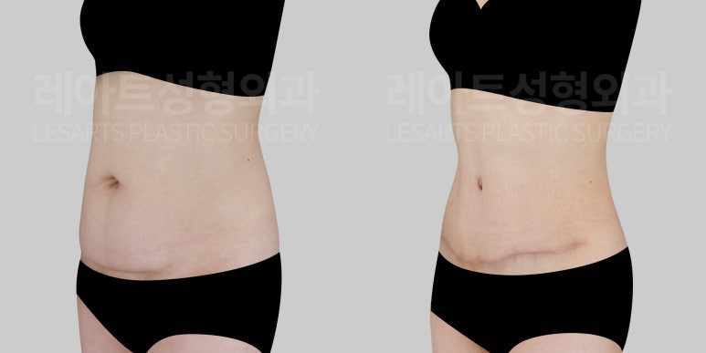 l-abdominoplasty-post21-06