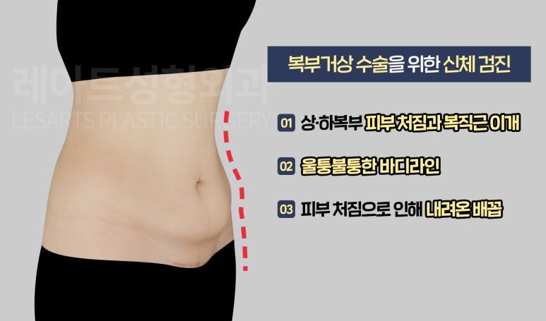 복부거상 수술전 플랜