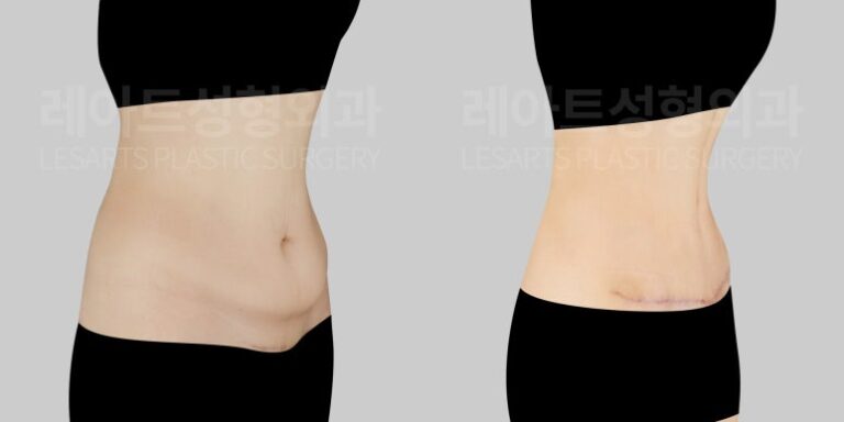 복부거상과 병행된 세로배꼽성형 - 레아트 이국한원장
