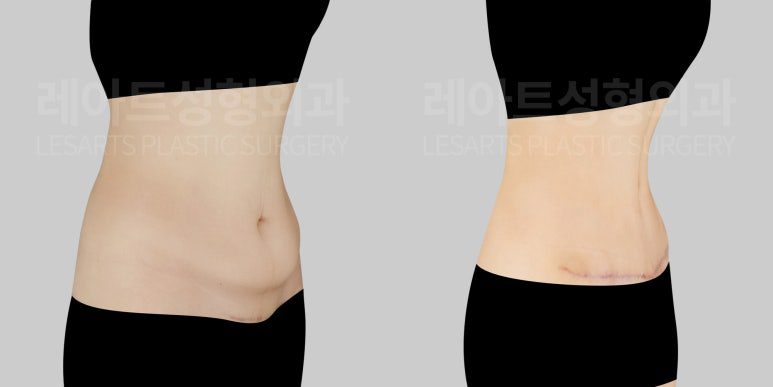 복부거상과 병행된 세로배꼽성형 - 레아트 이국한원장
