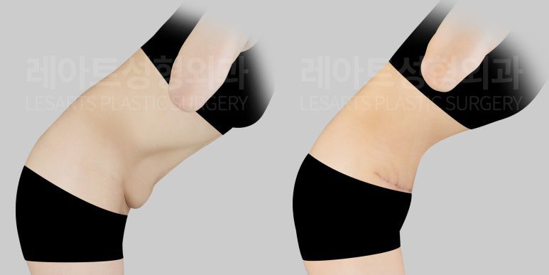 복부성형 후 주름과 처짐 개선 정도- 레아트성형외과 이국한 원장
