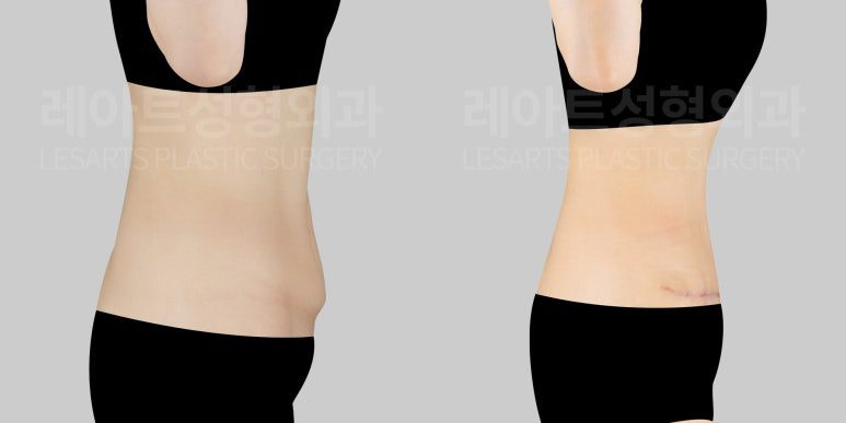 복부거상 수술 후 아랫배 돌출 개선 정도 - 레아트성형외과
