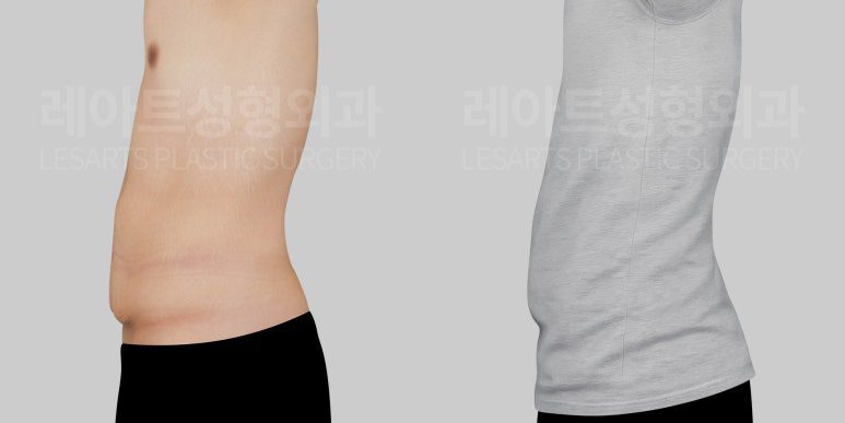 복부거상수술 전 옷핏 - 레아트성형외과