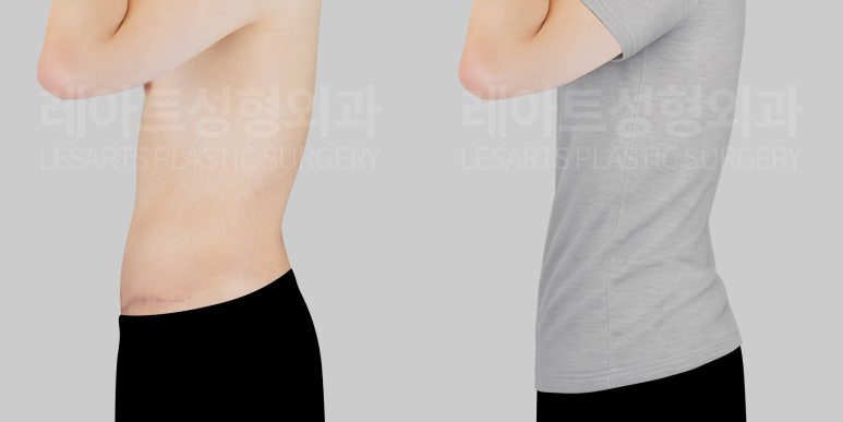 복부거상술 후 옷핏 변화 - 레아트성형외과