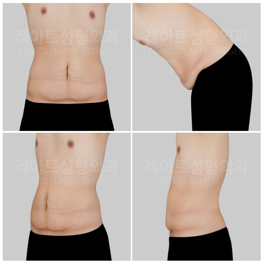 남성 복부거상술을 위한 신체 검진