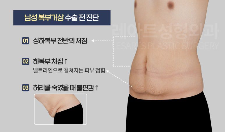 남성 복부거상 수술 전 상담