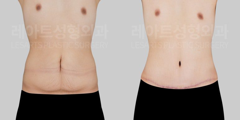 남자 복부거상수술 전후 비교-레아트 이국한 원장