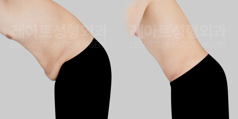 복부거상 수술 후 아랫배 처짐 개선 효과 - 레아트성형외과
