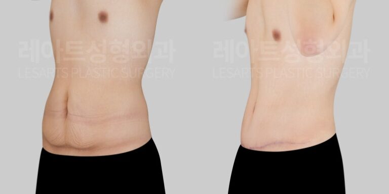 남성 처진 뱃살 수술 - 레아트 복부거상술 이국한 원장