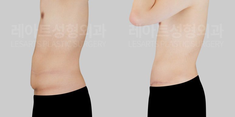 복부거상 전후 차이 - 레아트 성형외과 이국한 원장