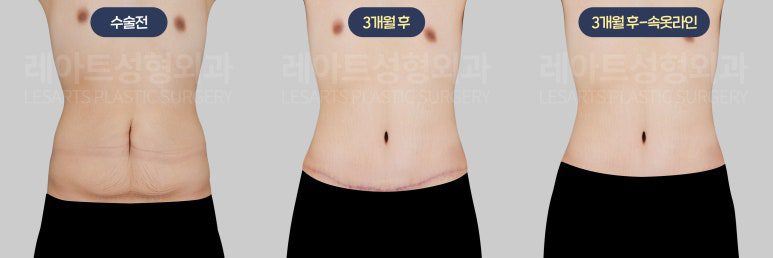 복부거상수술 흉터 위치 - 레아트 이국한 원장