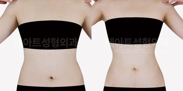 복부 지방흡입 전후모습 - 레아트성형외과