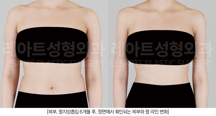 복부지방흡입 & 팔지방흡입 전후 비교 모습 - 레아트 성형외과