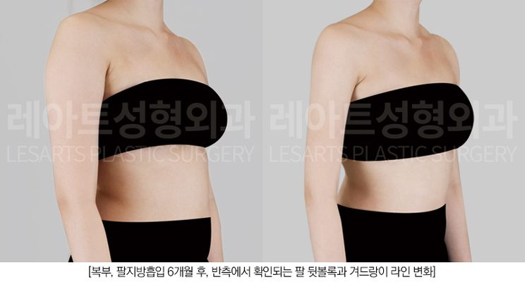 팔지방흡입 전후사진 비교