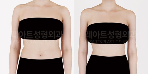 복부지방흡입 | 복부와 팔지방흡입이 동시에 진행된 수술 케이스 전후 비교 분석