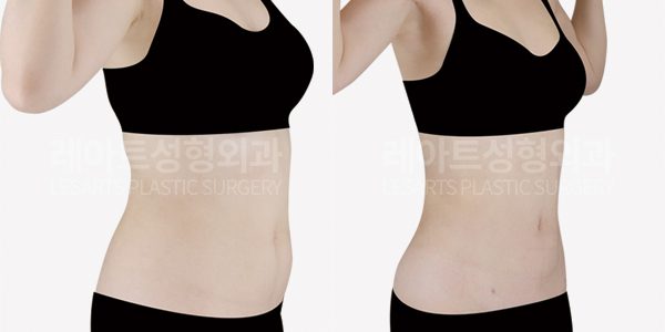 복부지방흡입 | 예비신부 뱃살다이어트 고민, 복부(옆구리, 러브핸들, 아랫배)지방흡입 후