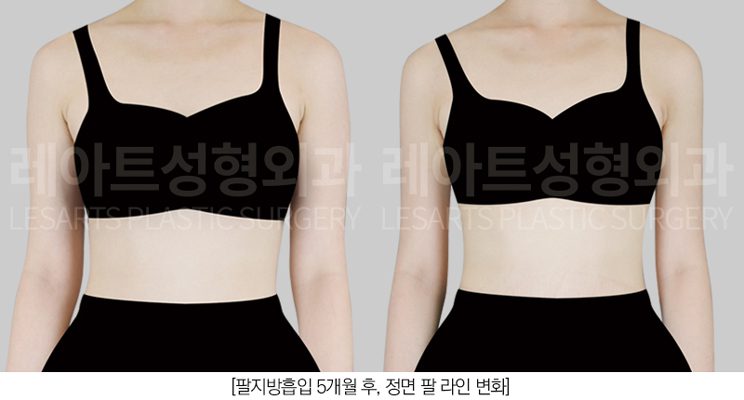 예신 팔 지방흡입 전후사진 - 레아트 성형외과