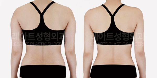 팔지방흡입 전후, 팔뚝살 제거 3개월 차 라인 변화
