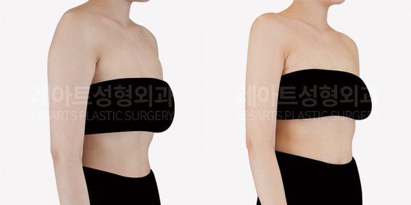 슬림한 체형 팔뚝살 고민, 팔지방흡입으로 여리여리한 일자팔 만드는 방법